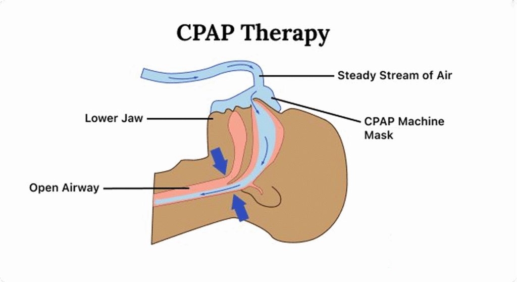 Understanding Cpap Trusted Sleep Clinic in Singapore – Expert Sleep Specialists