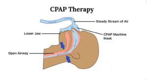 Lake Ridge Cpap Trusted Sleep Clinic in Singapore – Expert Sleep Specialists
